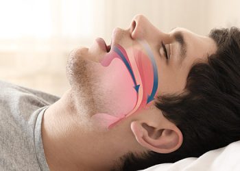 Operacija proti smrčanju – da ali ne?